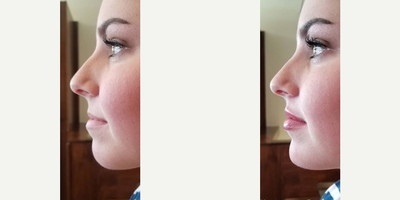 Facial before and after photo