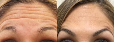 Botox before and after photo
