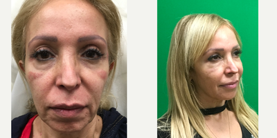 Dermal Fillers before and after photo
