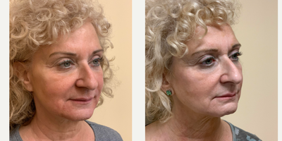 Dermal Fillers before and after photo