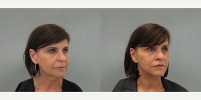 Lip Lift before and after photo
