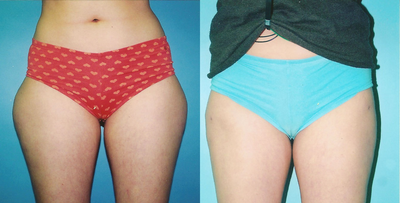Liposuction before and after photo