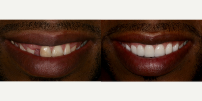 Porcelain Veneers before and after photo