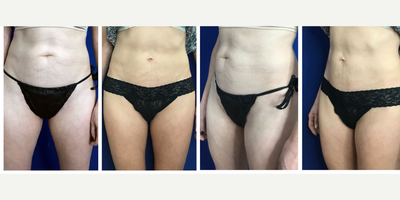 Renuvion before and after photo