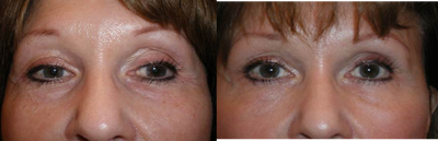 Restylane before and after photo