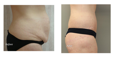 Tummy Tuck before and after photo