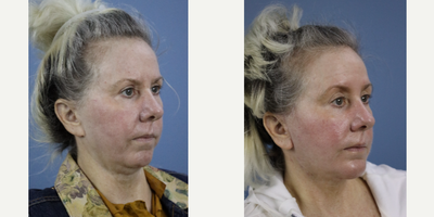 Chin Implant before and after photo