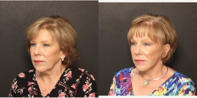 Facelift before and after photo