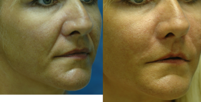 Radiesse before and after photo