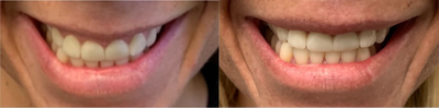 Botox for Gummy Smile before and after photo