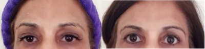 Botox before and after photo