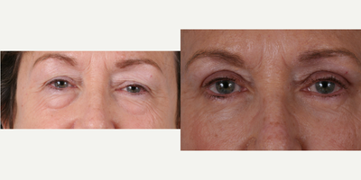 Eyelid Surgery before and after photo