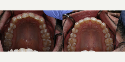 Invisalign before and after photo