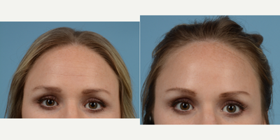Botox before and after photo