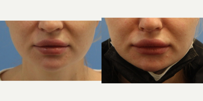 Botox before and after photo