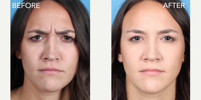 Botox before and after photo
