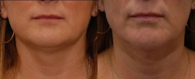 before and after image