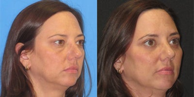 Eyelid Surgery before and after photo
