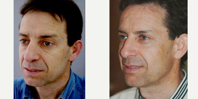 Facial Fat Transfer before and after photo