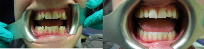 Invisalign before and after photo
