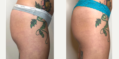 Sculptra before and after photo