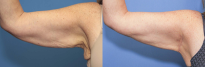 Arm Lift before and after photo