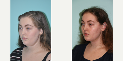Chin Liposuction before and after photo