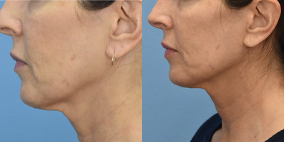 Dermal Fillers before and after photo