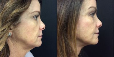 Facelift before and after photo