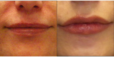 Juvederm before and after photo
