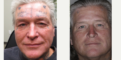 Tattoo Removal before and after photo