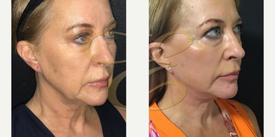 Facelift before and after photo
