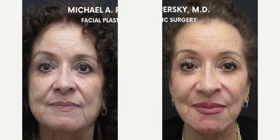 Lip Fillers before and after photo