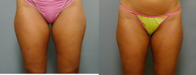 SlimLipo before and after photo