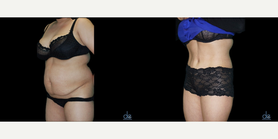 Tummy Tuck before and after photo