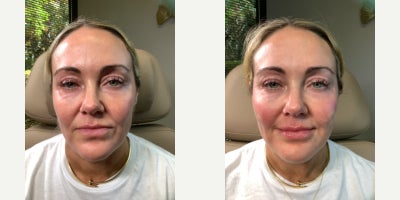 Cheek Fillers before and after photo