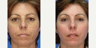 IPL before and after photo