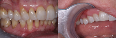 Pinhole Gum Surgery before and after photo
