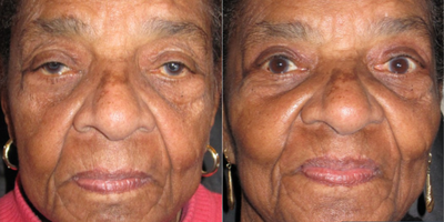 Ptosis Surgery before and after photo