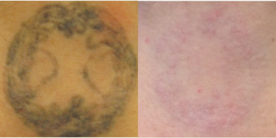 Tattoo Removal before and after photo