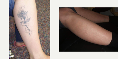 Tattoo Removal before and after photo