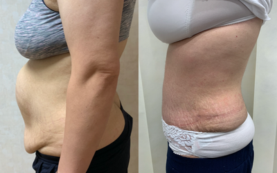 Tummy Tuck before and after photo