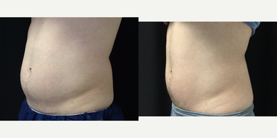 CoolSculpting before and after photo