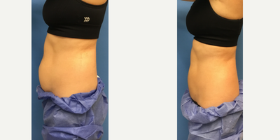 CoolSculpting before and after photo