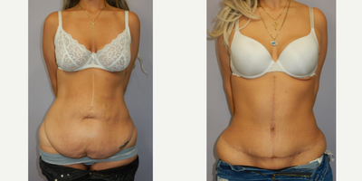 Panniculectomy before and after photo