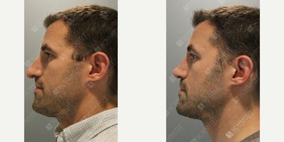 Rhinoplasty before and after photo