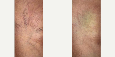 YAG Laser before and after photo