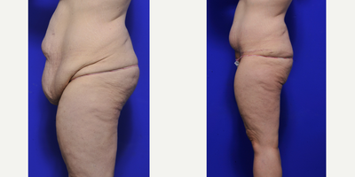Body Lift before and after photo