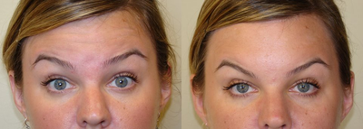 Dysport before and after photo