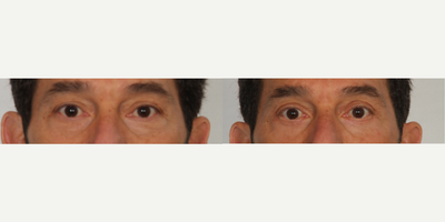 Eyelid Surgery before and after photo